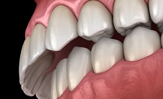 Illustration of an overbite