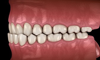 Illustration of an underbite