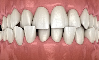 Illustration of a crossbite