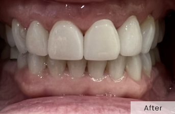 Close-up of teeth after treatment