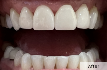 Close-up of smile with repaired lower teeth