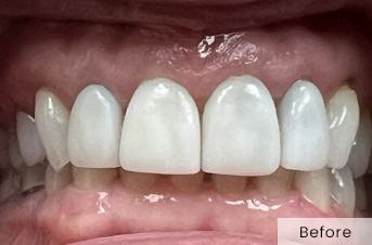 Close-up of teeth with darkened areas