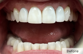 Close-up of smile with worn-down lower teeth