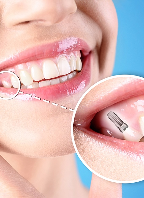Dental implants have a variety of benefits beyond creating a beautiful smile