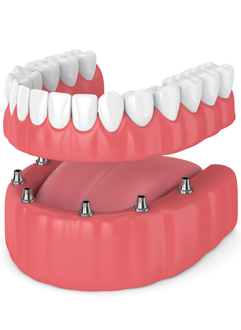 Illustration of implant dentures in Rockwall