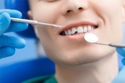 We can repair your cavities and broken teeth near Mobile City