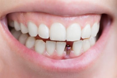 We offer a variety of tooth replacement options near Mobile City