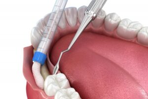 Animated bone graft procedure.